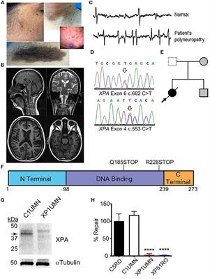 Case Report: Identification of a Heterozygous XPA c.553C>T Mutation Causing Neurological Impairment in a Case of <mark class="highlighted">Xeroderma</mark> Pigmentosum Complementation Group A
